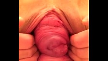 Insane prolapse